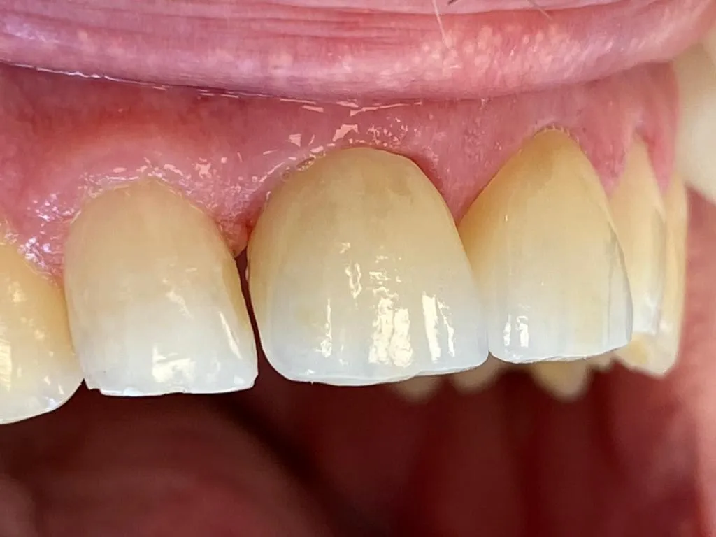 Weiße Zähne bei Dr. Vellai in Eimsbüttel